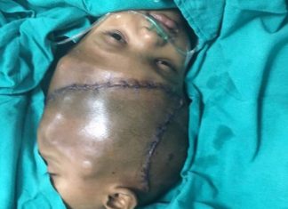 Indian Surgeons Separate Conjoined Twins